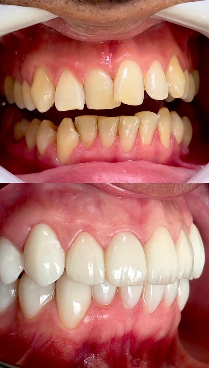 Antes e depois do tratamento