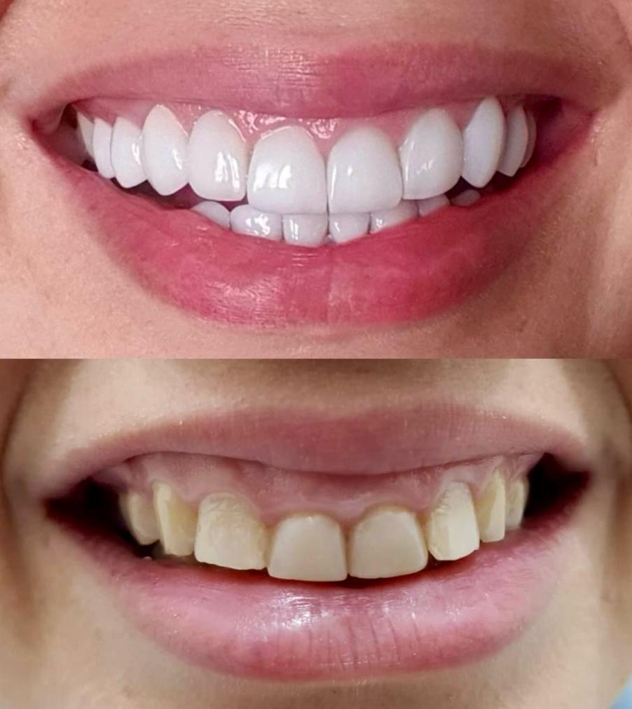 Antes e depois do tratamento