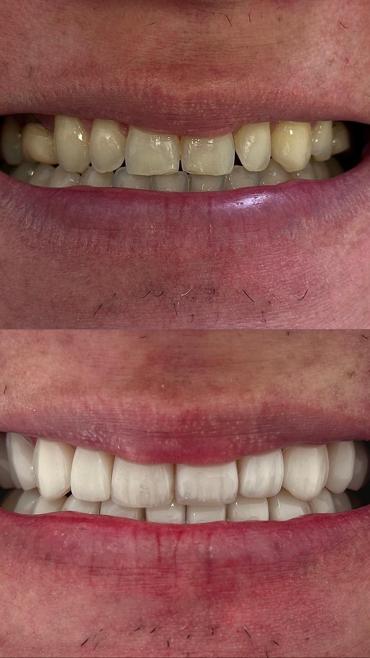 Antes e depois do tratamento