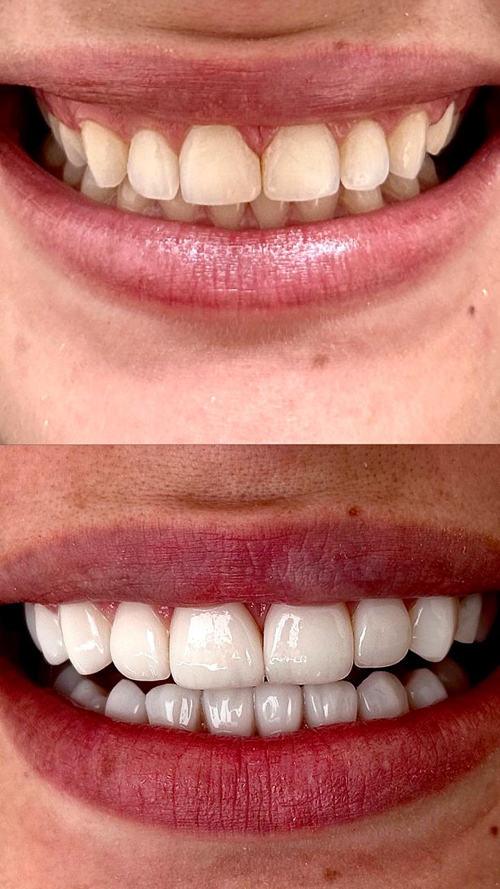 Antes e depois do tratamento