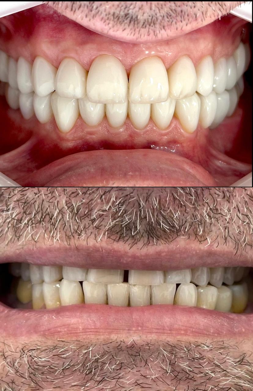 Antes e depois do tratamento