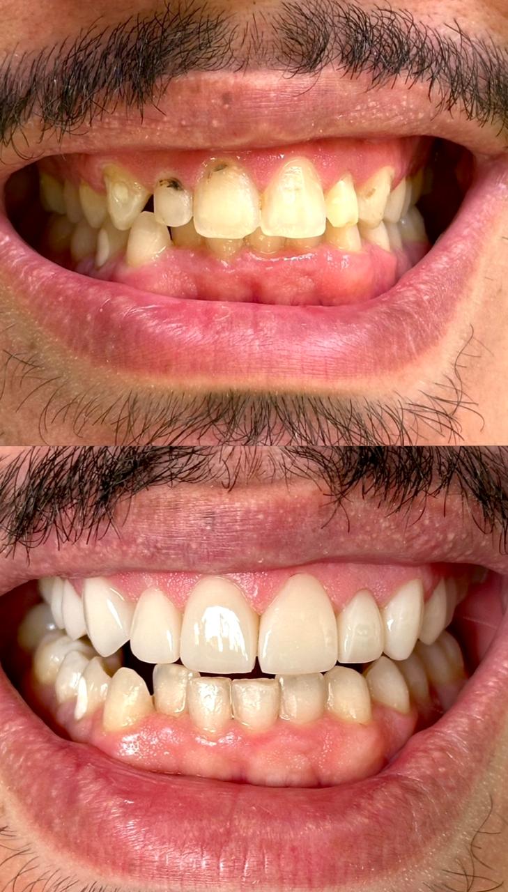 Antes e depois do tratamento